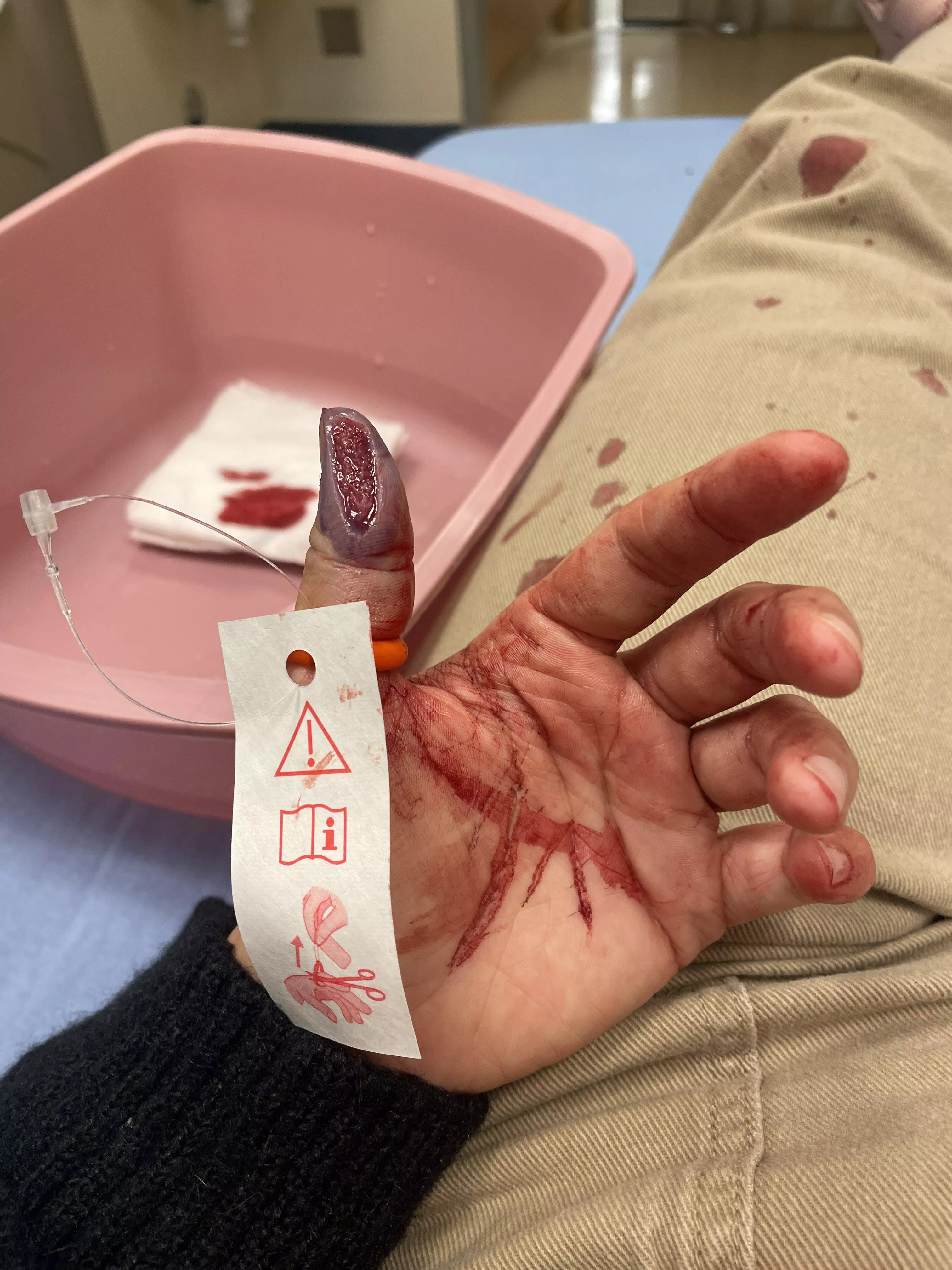 Chunk of thumb sliced off 