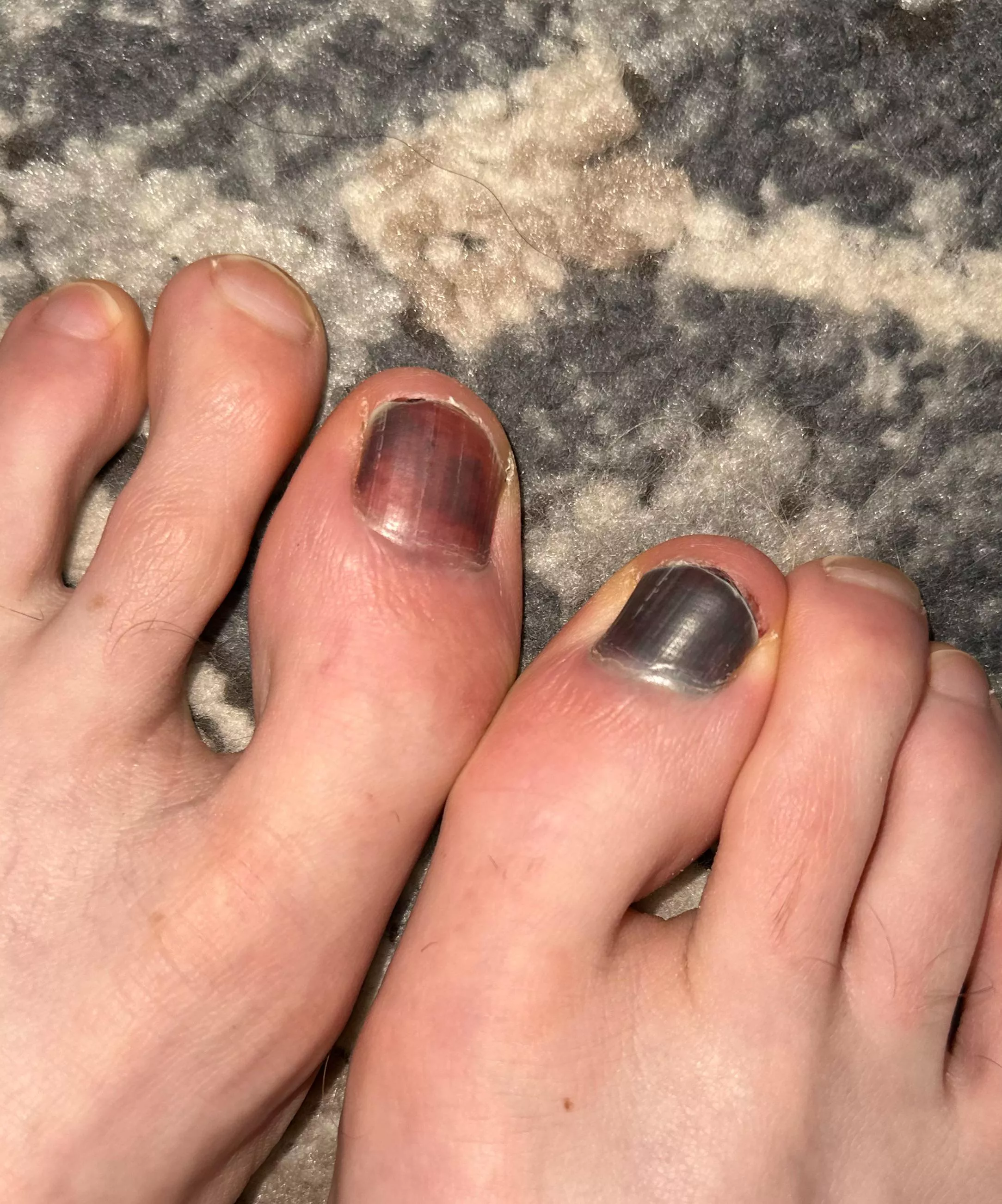 How long until I lose them, 24 hour trail run race did some damage 