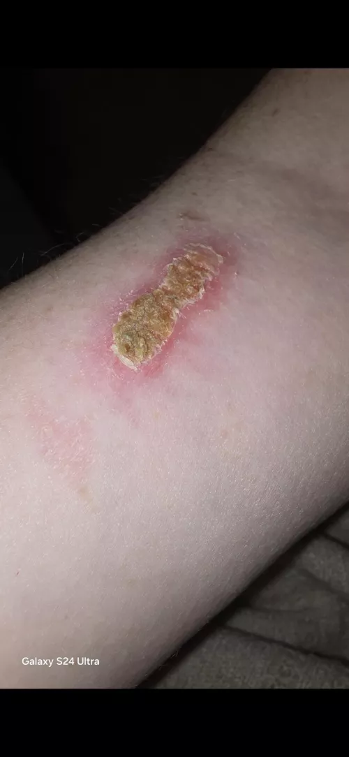 Infected burn 