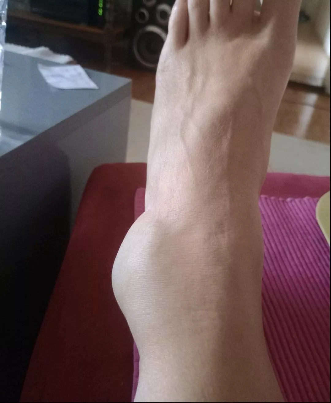 My aunt broke her ankle