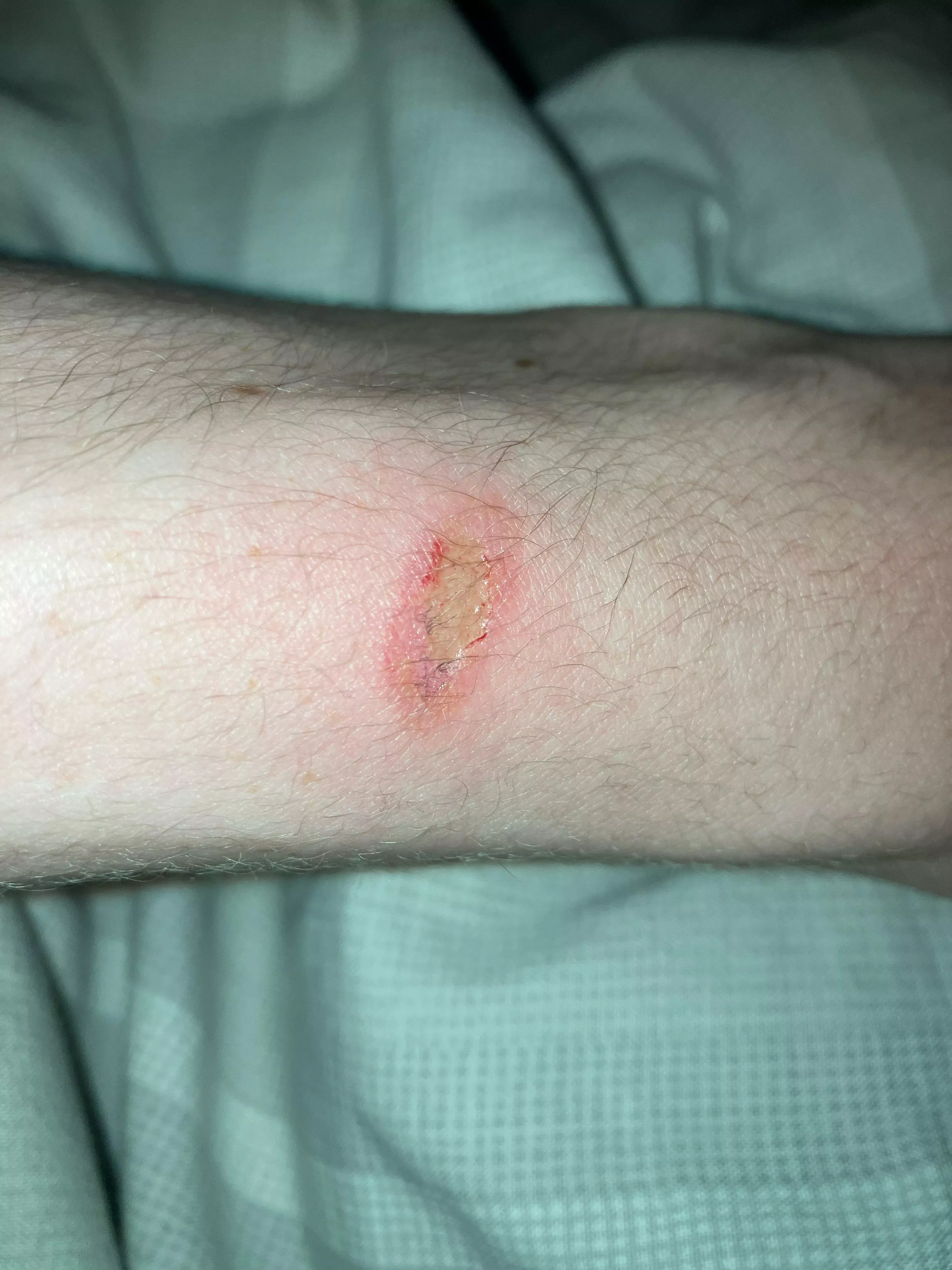 What is this on my arm?