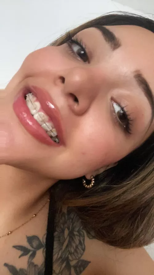 Does my smile suit me with braces