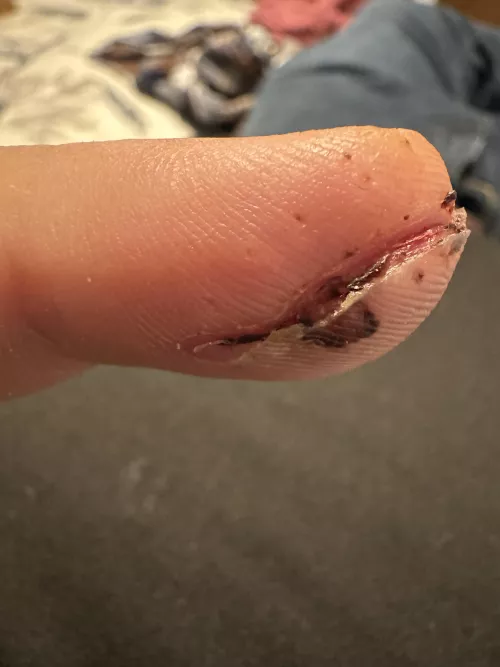 Did my doctor suck at stitches? (Removed stitches on middle finger 2 days ago after having them In for 10 days)