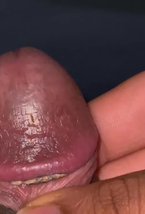 Is this phimosis and what is this blue and grey stuff on my skin. I’m so sorry I’ve never been taught about these things. 