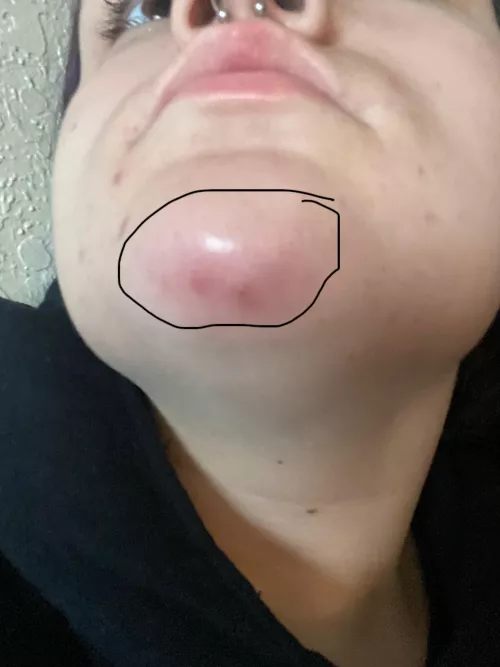 Is this worry some ? Painful large bump on chin