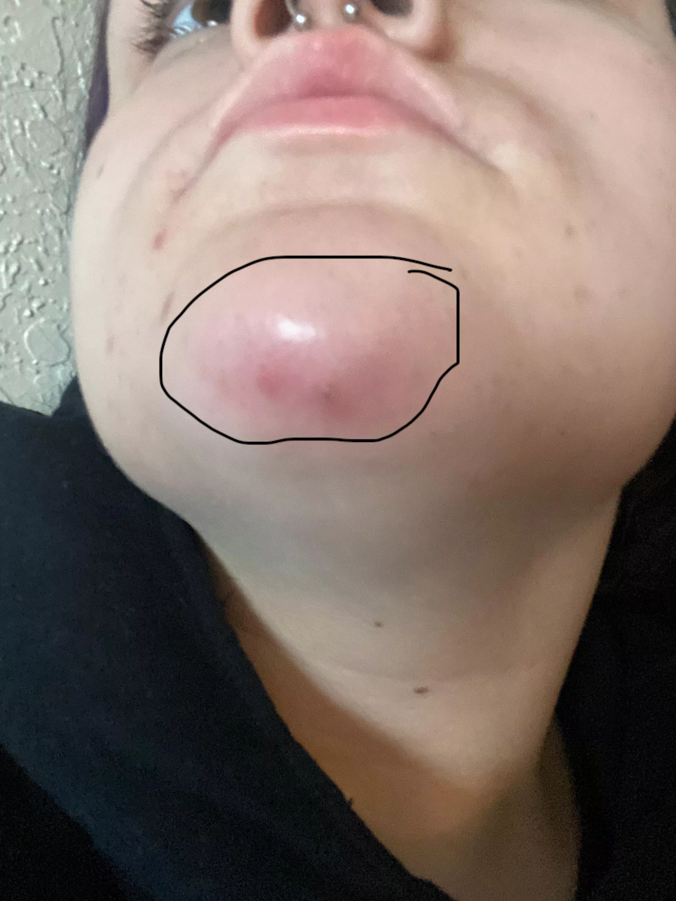 Is this worry some ? Painful large bump on chin