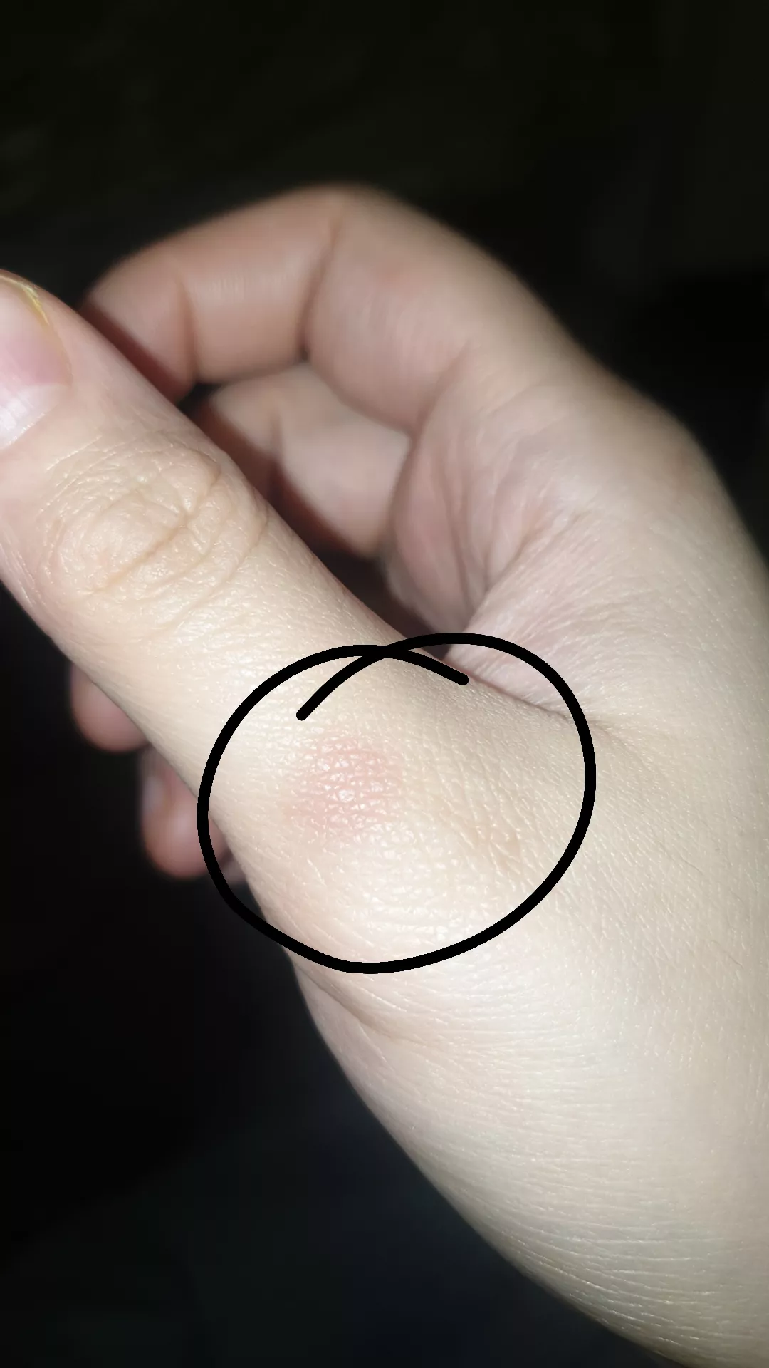 Red circular spot on my thumb joint