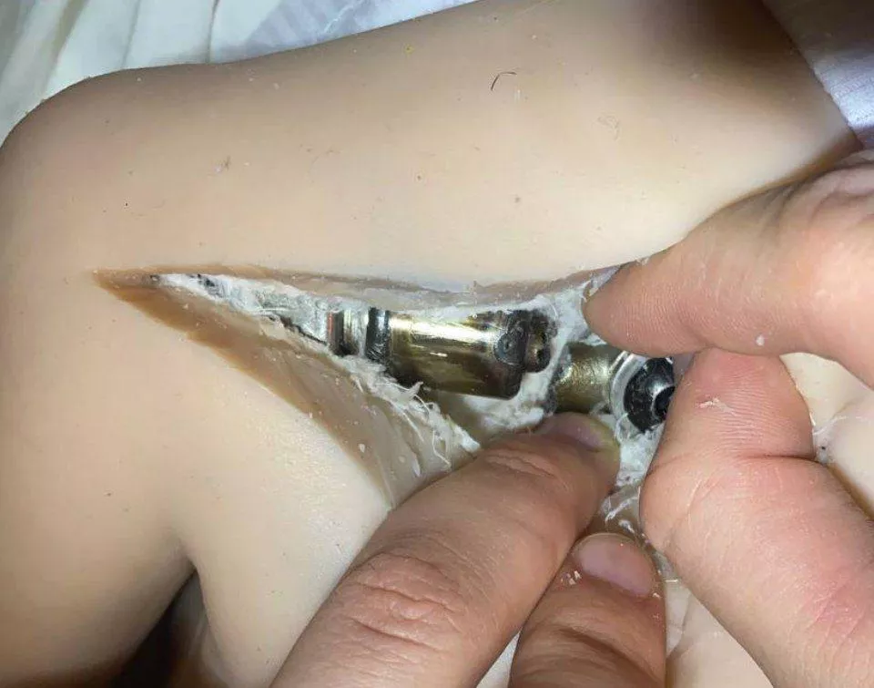 Who has any ideas? Fracture in the shoulder area