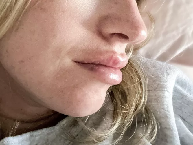 Fresh from my recent filler touch-up!