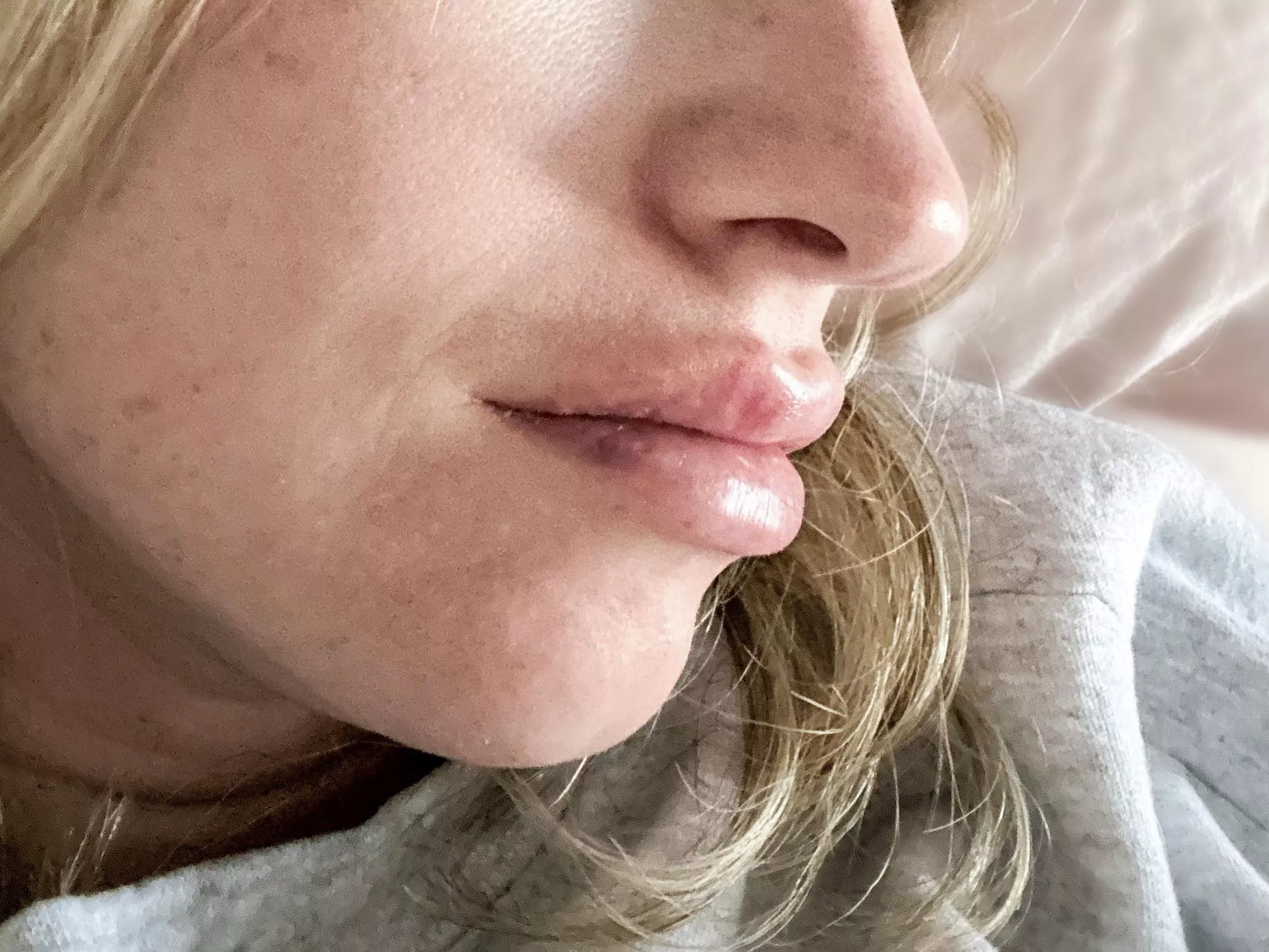 Fresh from my recent filler touch-up!