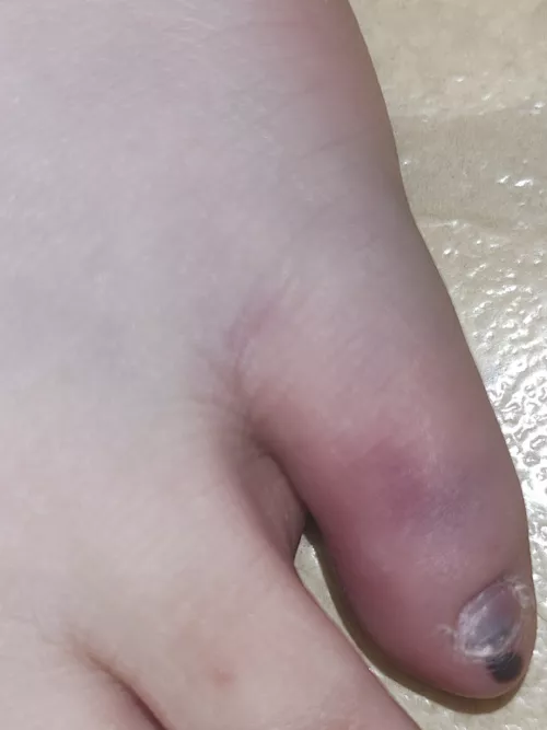 Jammed my pinkie toe