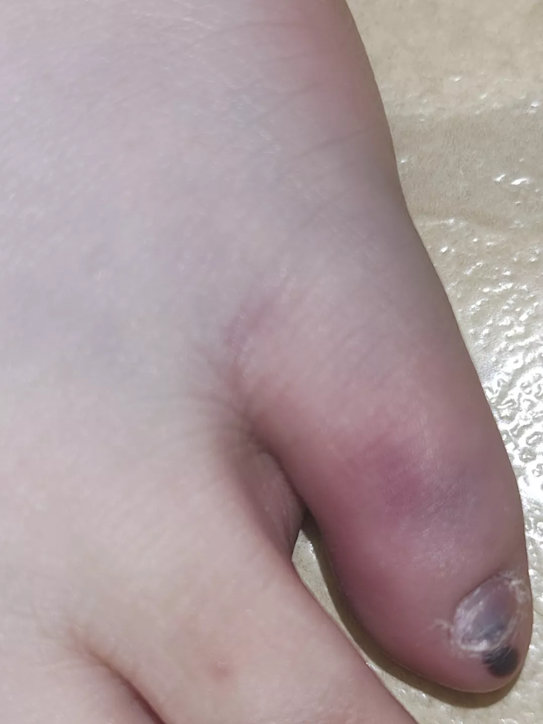 Jammed my pinkie toe