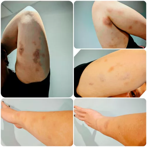 I has owwies from grapple pit last night 