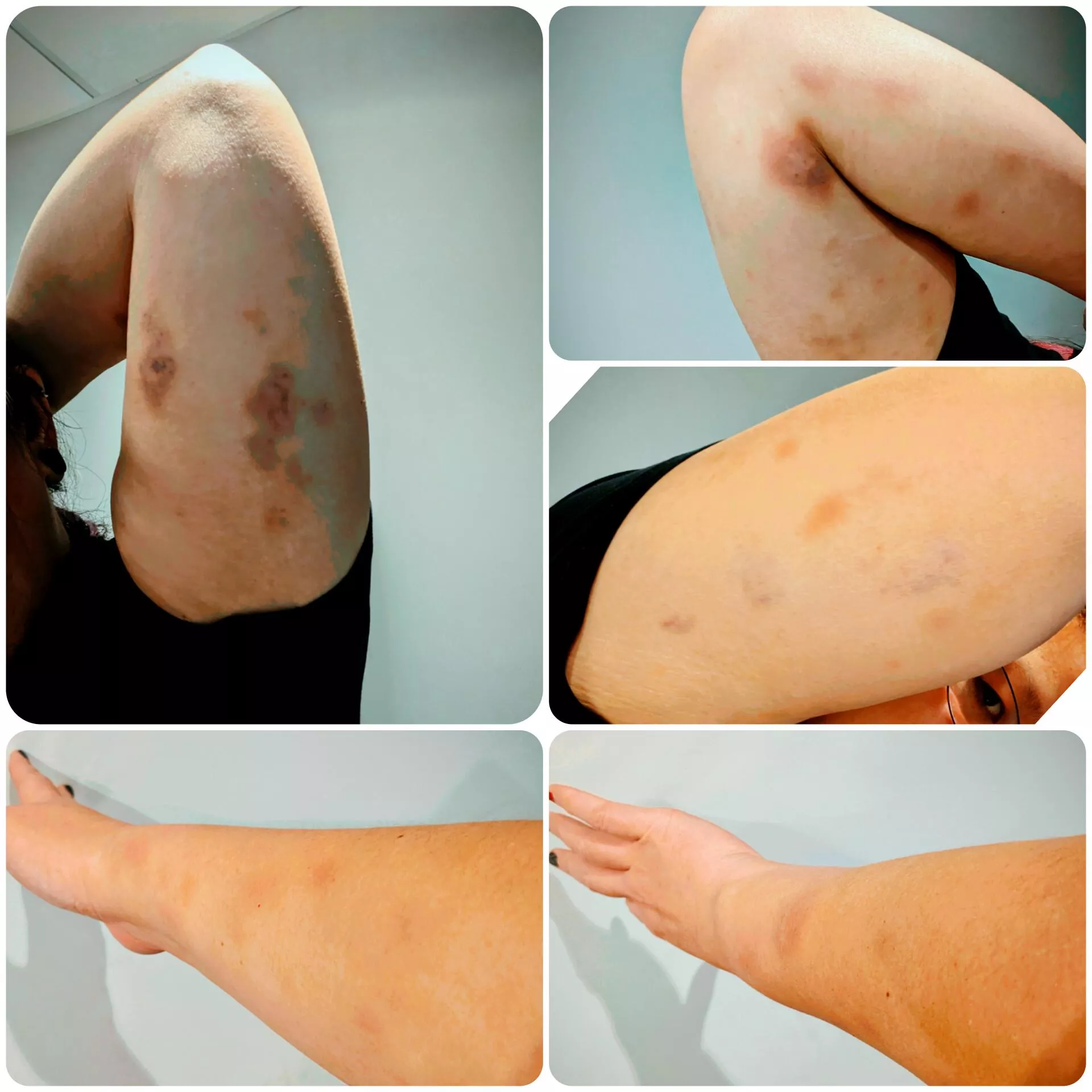 I has owwies from grapple pit last night 