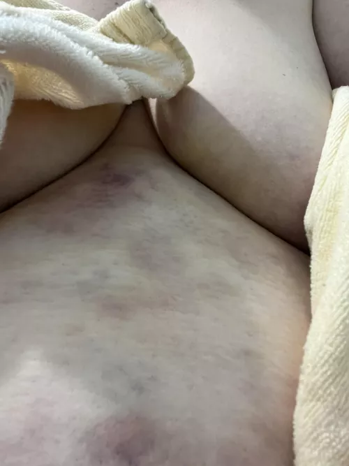 My lover loves biting me all over