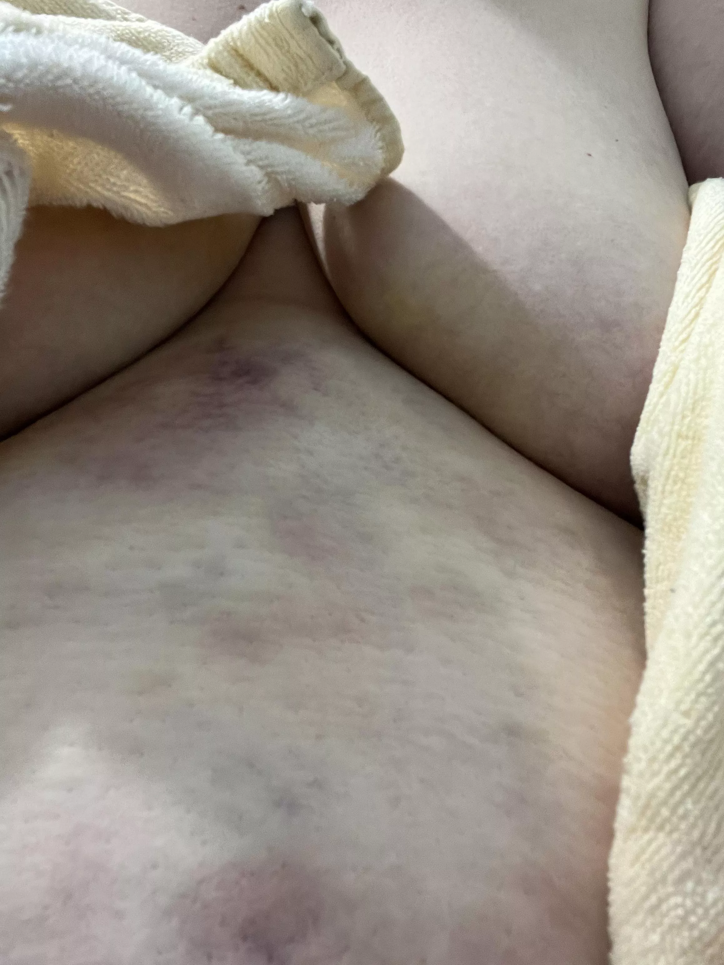 My lover loves biting me all over