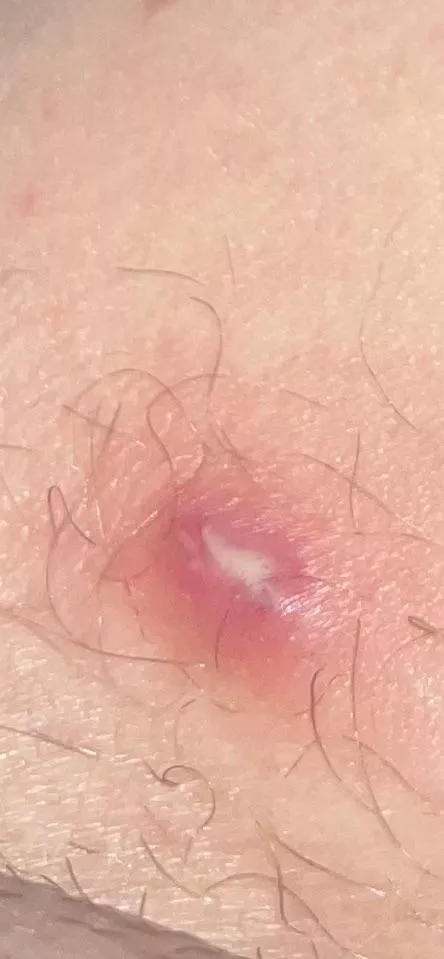 26f. painful bump on upper inner thigh kept going away and coming back, i put a drawing slave on for a few days and now it looks like this. i have a dr appt wednesday but is it just a really deep pimple? 