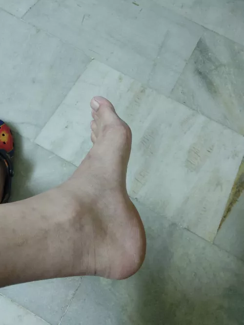 Guess my age looking at my feet skin!