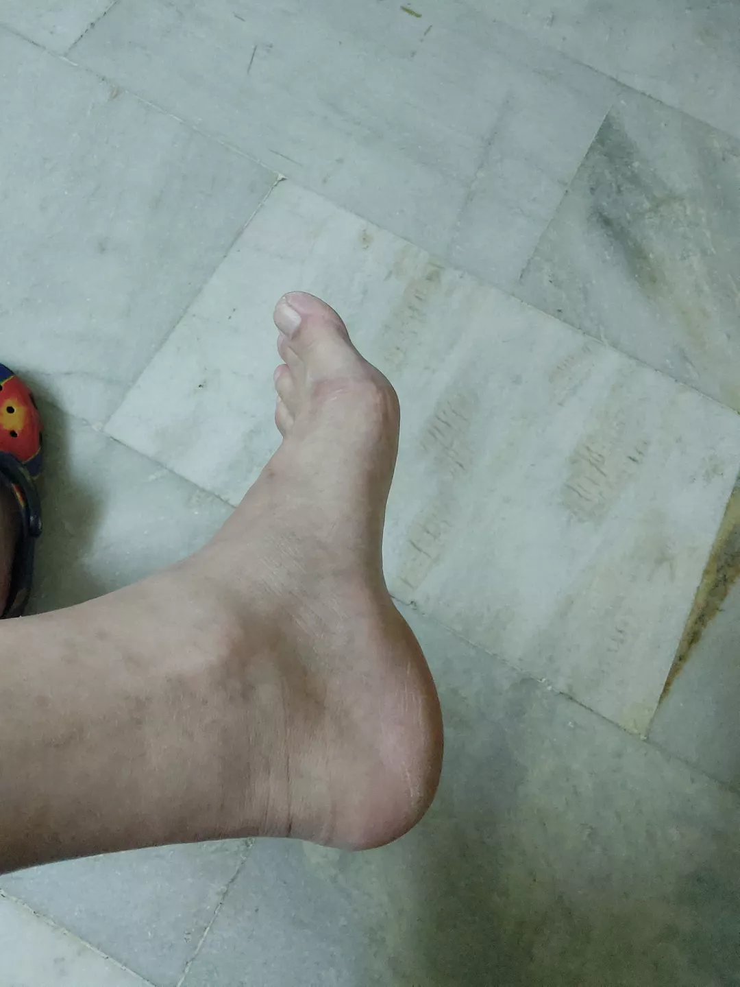 Guess my age looking at my feet skin!