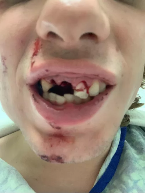 Jumped by 4 people, 3 teeth gone