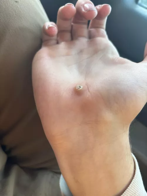 Mass? growing on my hand. i thought it was a splinter at first, now im thinking possibly a wart.