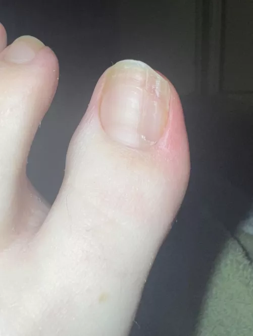 My left big toe toenail has been growing ridges like this for 6+ years now. Is there a way for it to ever grow normal again?