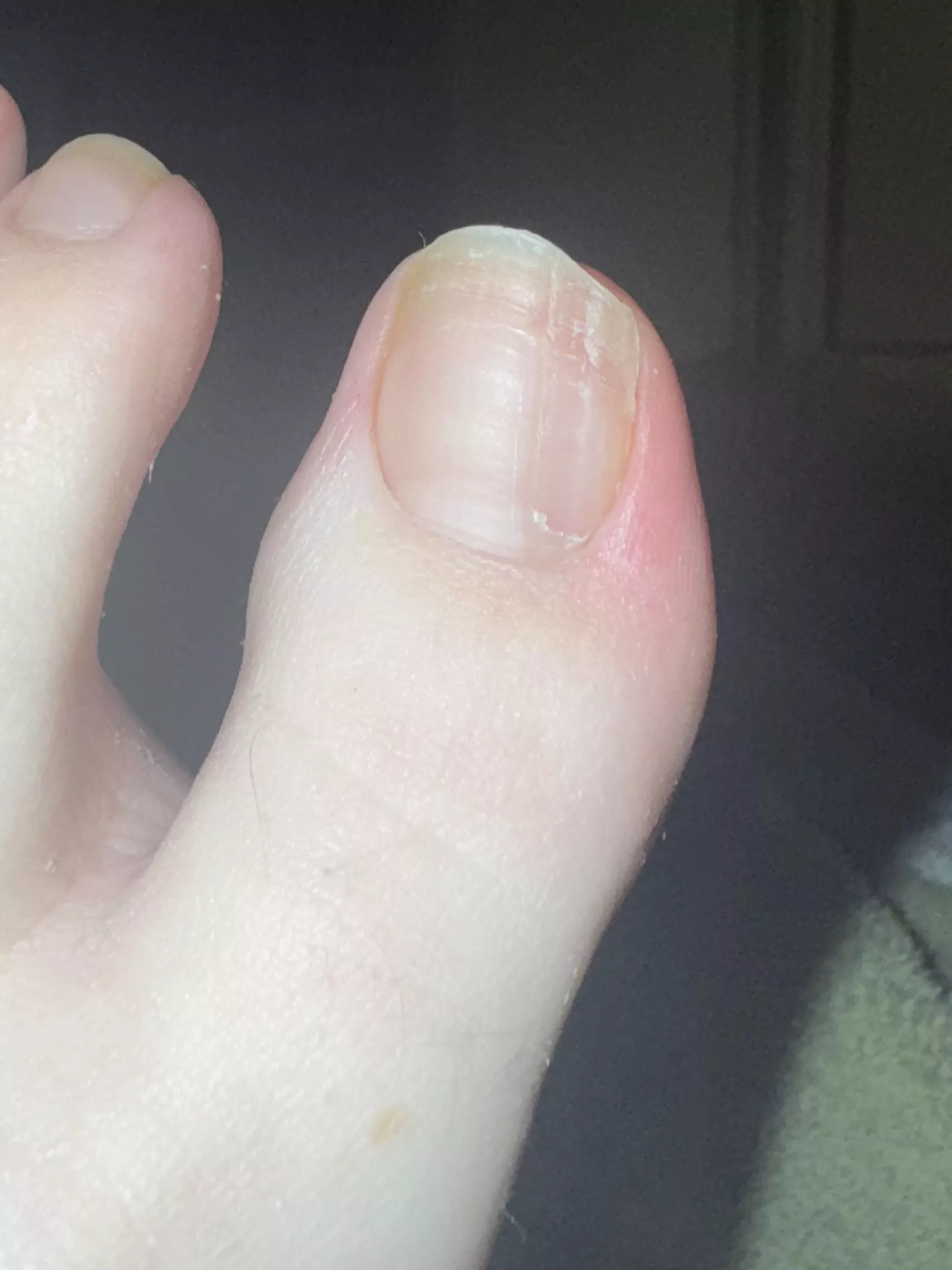 My left big toe toenail has been growing ridges like this for 6+ years now. Is there a way for it to ever grow normal again?
