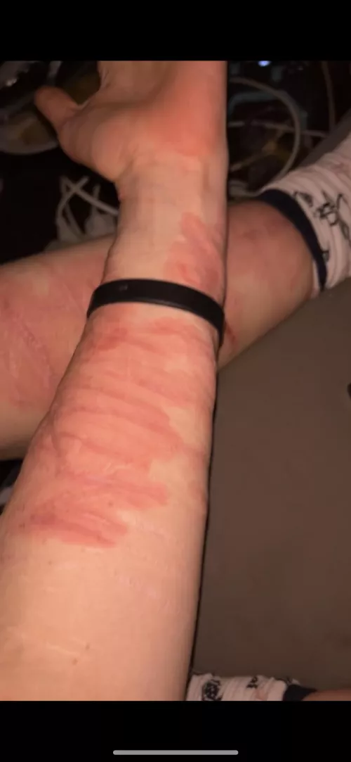 Possible allergic reaction on entire body? 