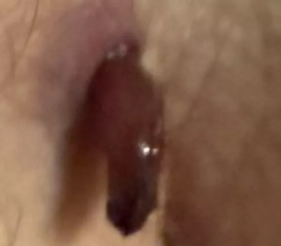 WTF IS THIS!? Should I go see my doc sooner?