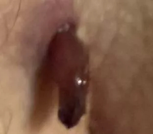 WTF IS THIS!? Should I go see my doc sooner?