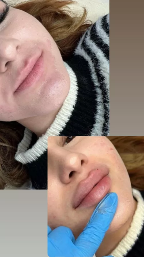 Before and after lip fillers