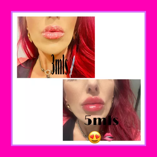 Freshly filled lips 👄 