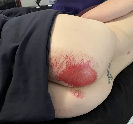 [partial nudity] My luckily very shallow but wide road rash after being the dumbest ever. Dress for the slide, not the ride