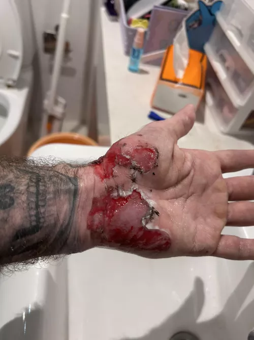 SEVERE Road Rash on Palm