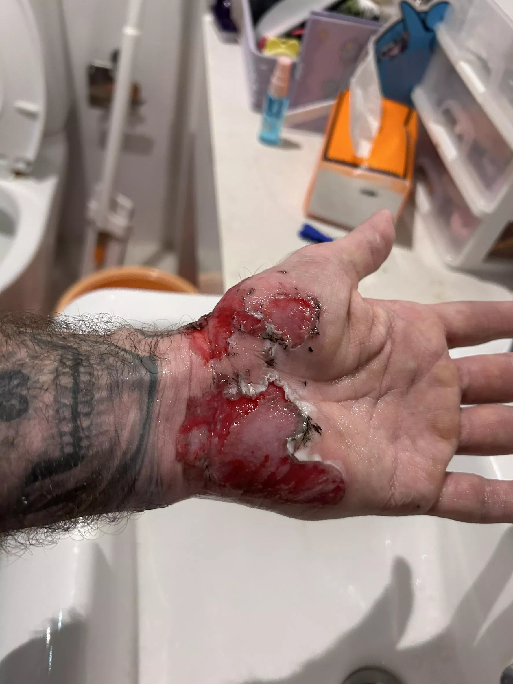 SEVERE Road Rash on Palm