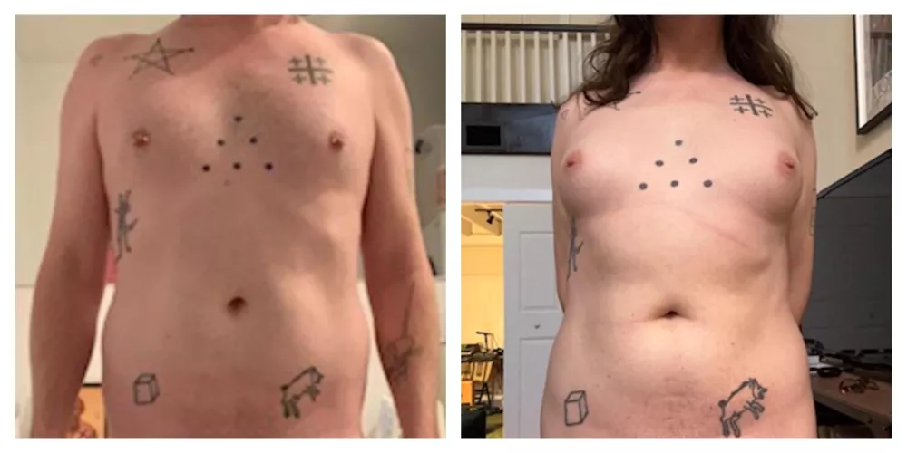 20 months weekly EV IM and oral prog.  39 years old