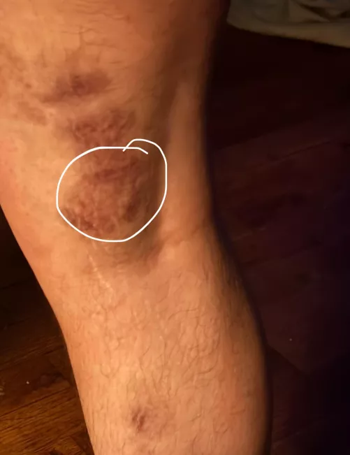 A giant weird bruise after a below skin feeling? 