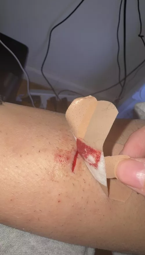 do i need stitches? I slipped with a box cutter