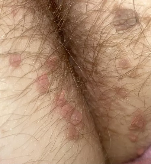 Growths on outside of butt (age 30)