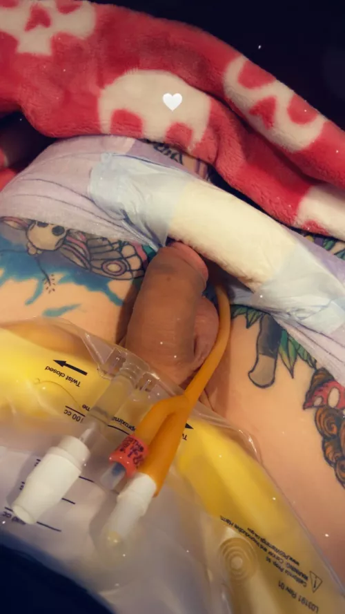 Have an 18fr in now. Should I Keep a bag attached or should I just let it drain into my diaper? 