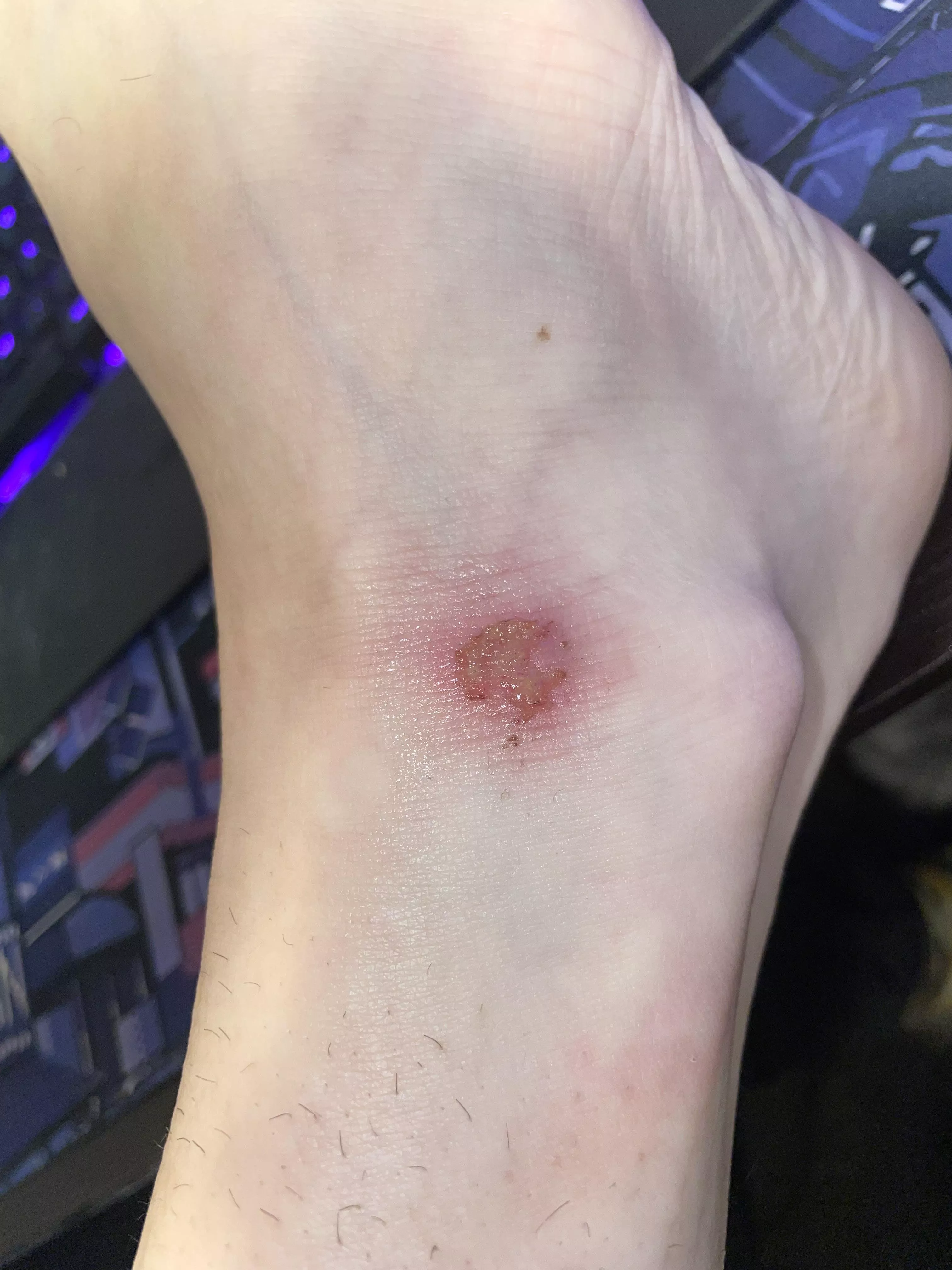 Is this Lymphangitis or am I overreacting?