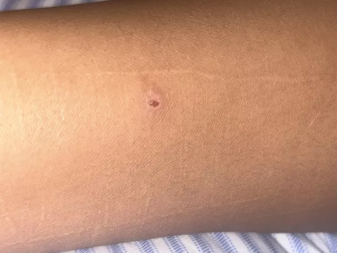 My girlfriend had this on her arm, and she doesn’t know what it is