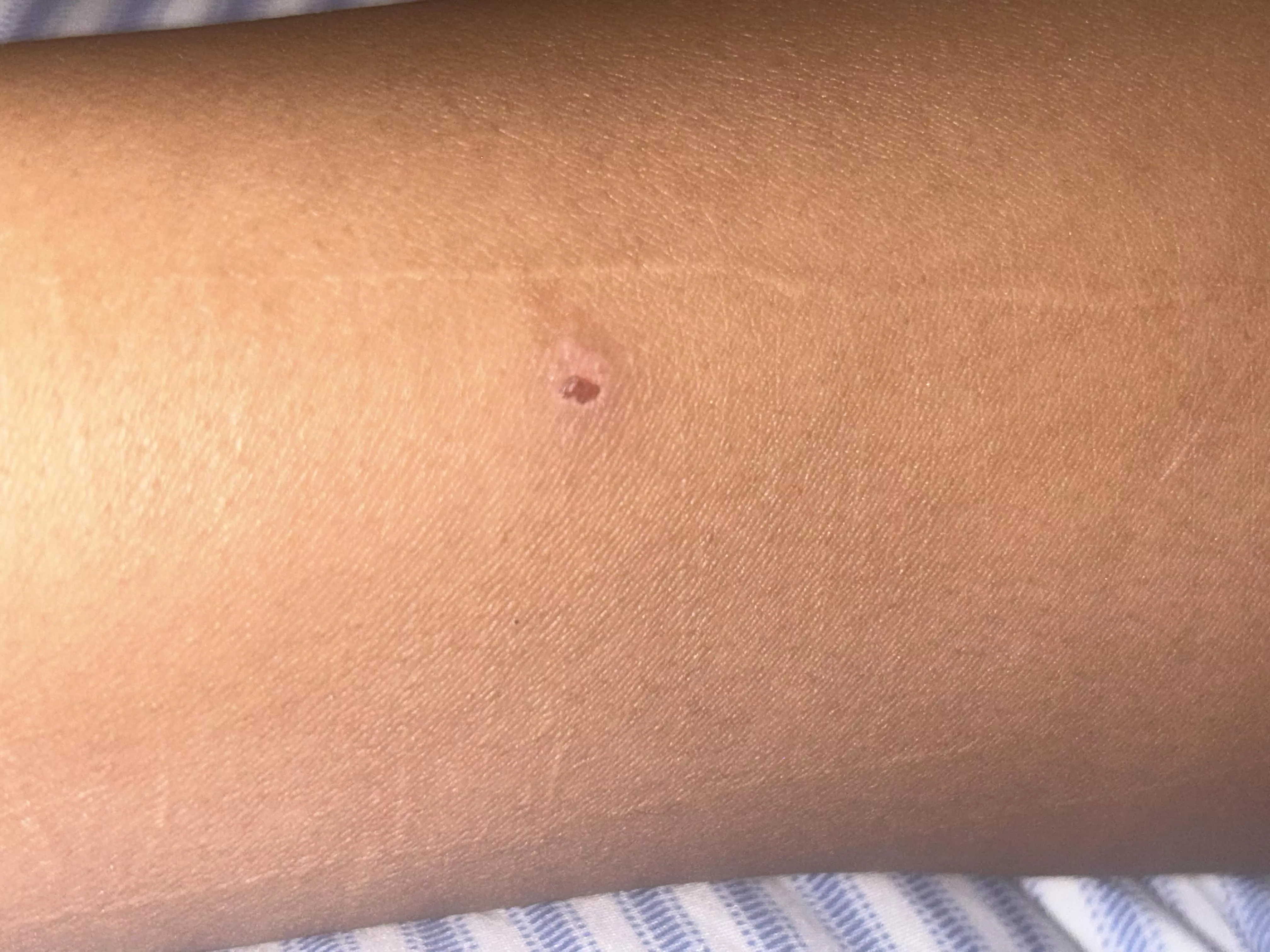 My girlfriend had this on her arm, and she doesn’t know what it is