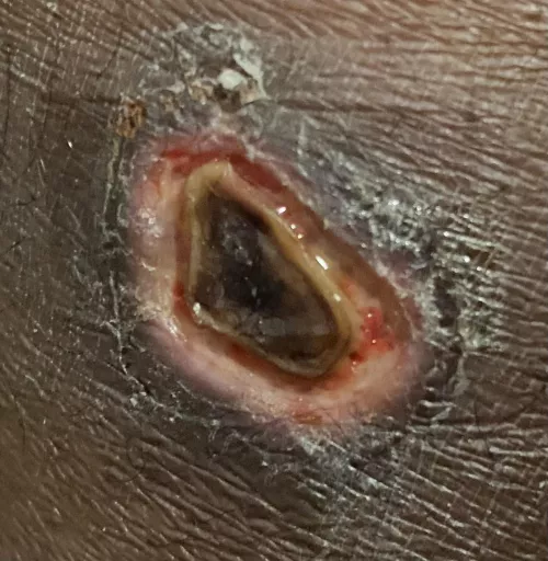 Possible Eschar / wound treatment