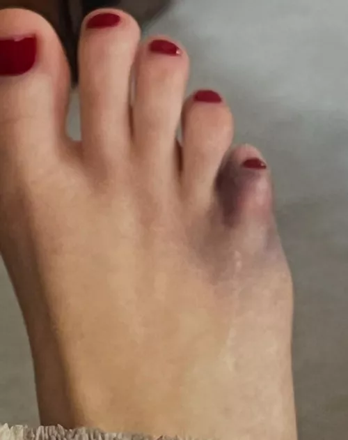 Stubbed pinky toe. Could it be broken?