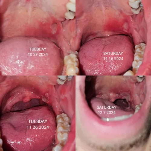 Canker sore from hell