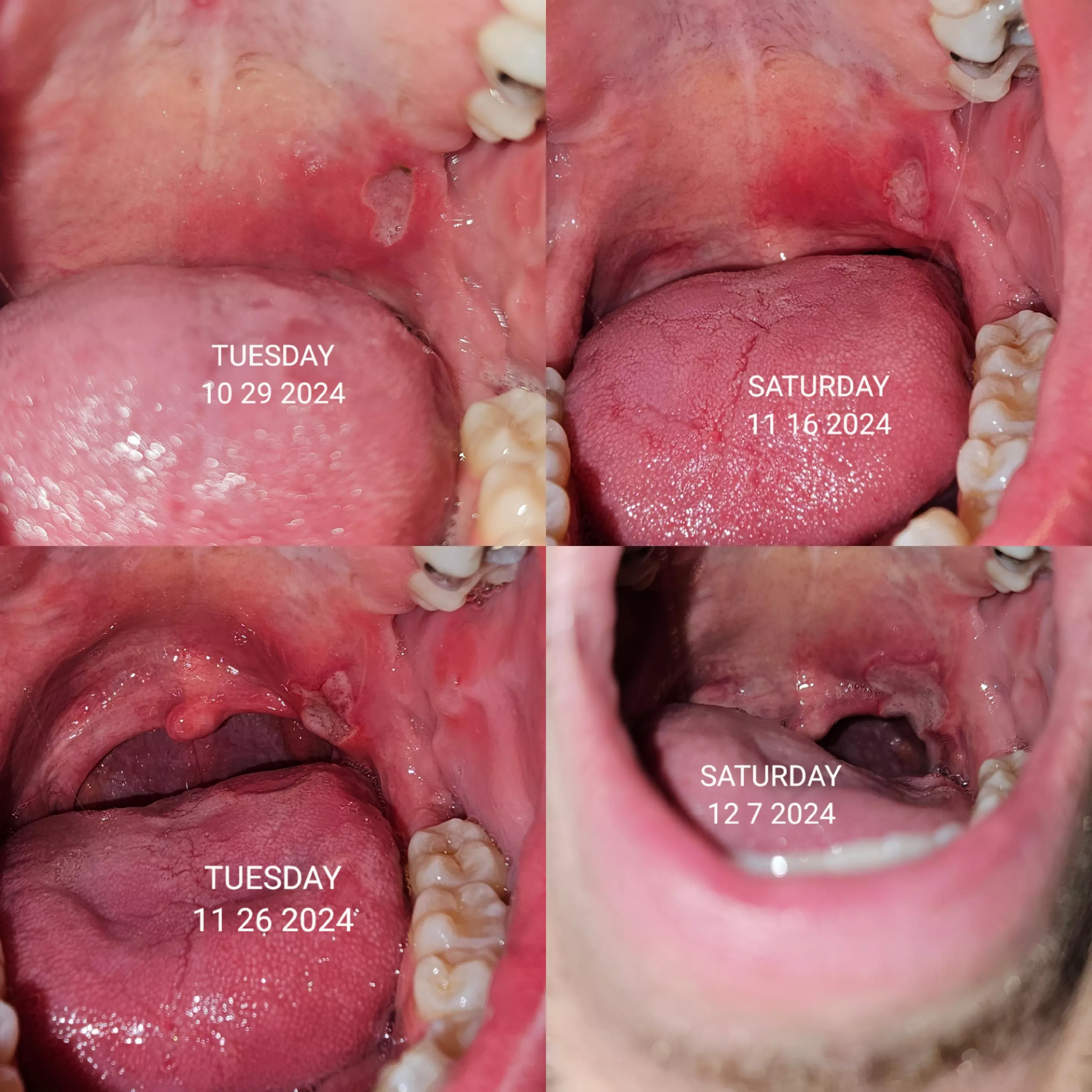 Canker sore from hell