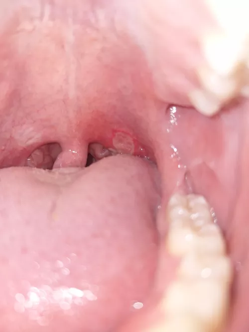 I too will post my canker sore from hell