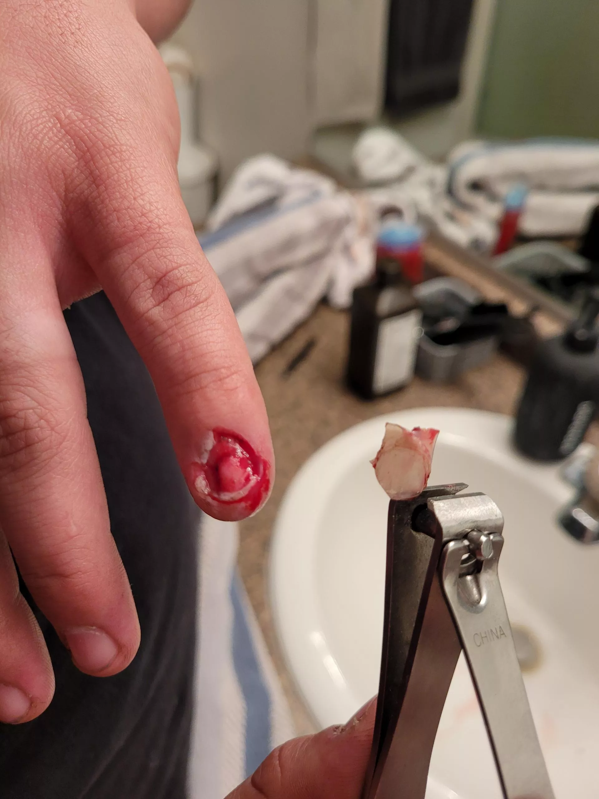 Pinky nail came right off