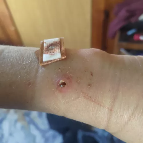 Surgical Pin Jumping Ship